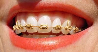 0.022/0.018 Slotgrootte DTC Orthodontische tandheelkundige gouden beklede brackets Brace Ortho stof