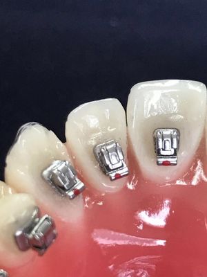 Clinic Molar Tubes Dental Lingual Brackets voor DTC Orthodontie Zelfbindende Bracket