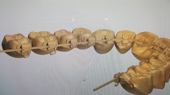 Krachtige machines Bron DTC Orthodontie Tongue Braces met zelfbindende brackets