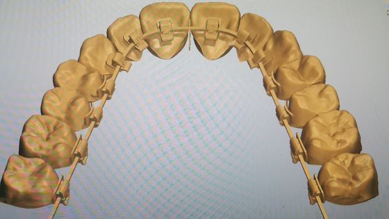 Krachtige machines Bron DTC Orthodontie Tongue Braces met zelfbindende brackets